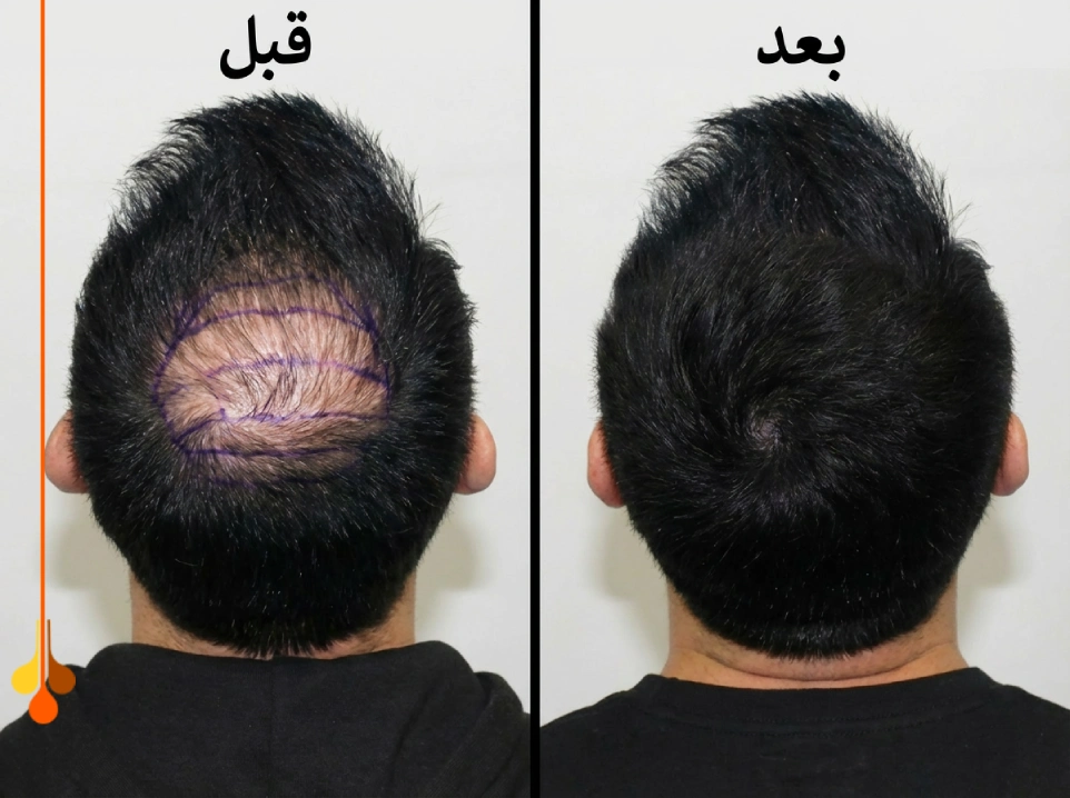 الترقق المنتشر