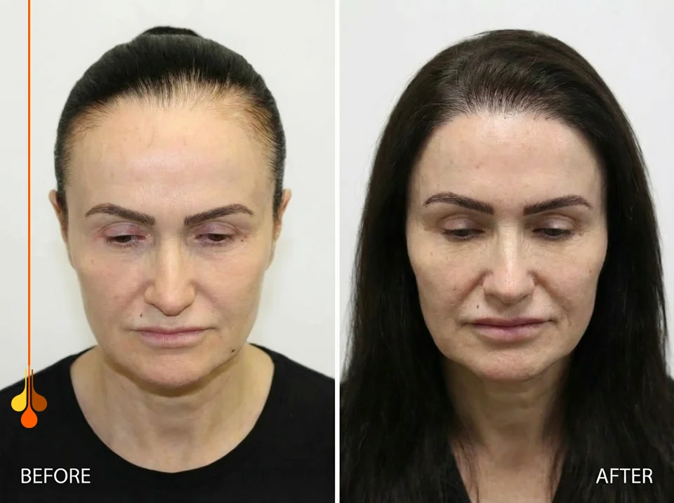 تصحيح خط الشعر عند النساء