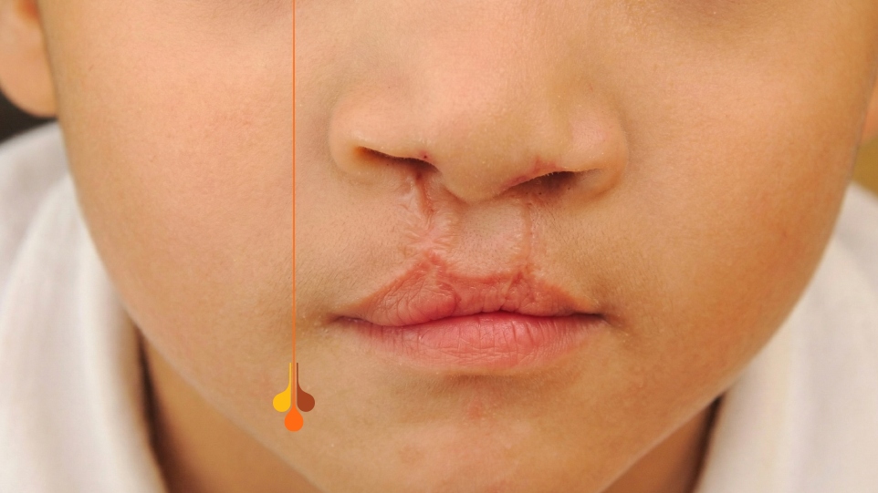 فیلر لب برای نقص مادرزادی