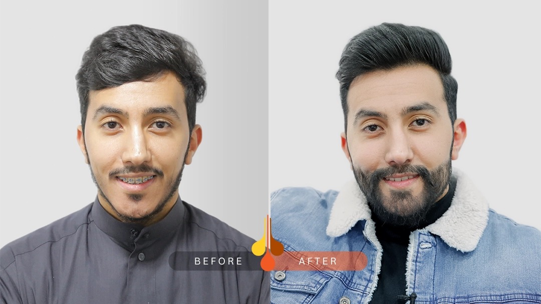 Beard & Moustache Transplant in Kuwait