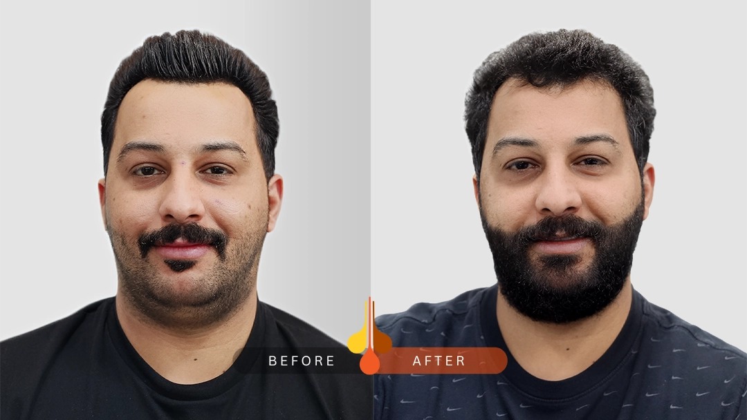 Beard & Moustache Transplant in Kuwait
