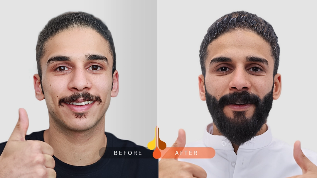 Beard & Moustache Transplant in Kuwait