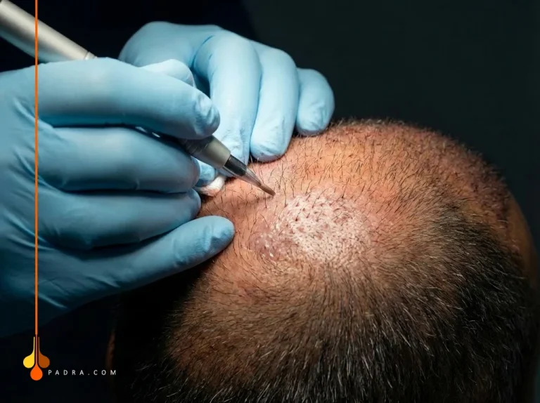 زراعة الشعر بتقنية DHI