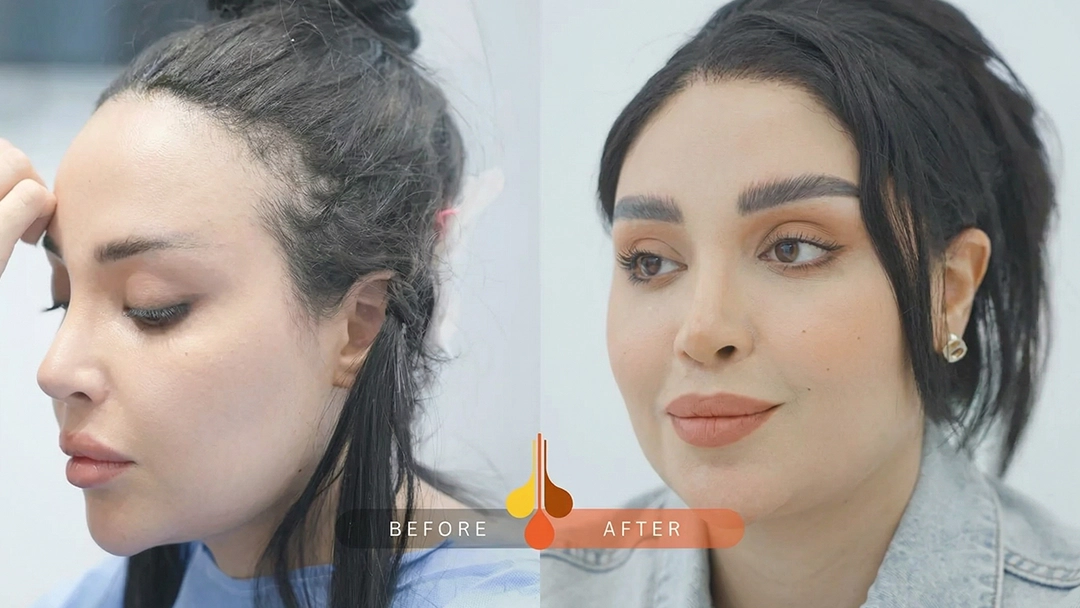 result of Women’s Hair Transplant