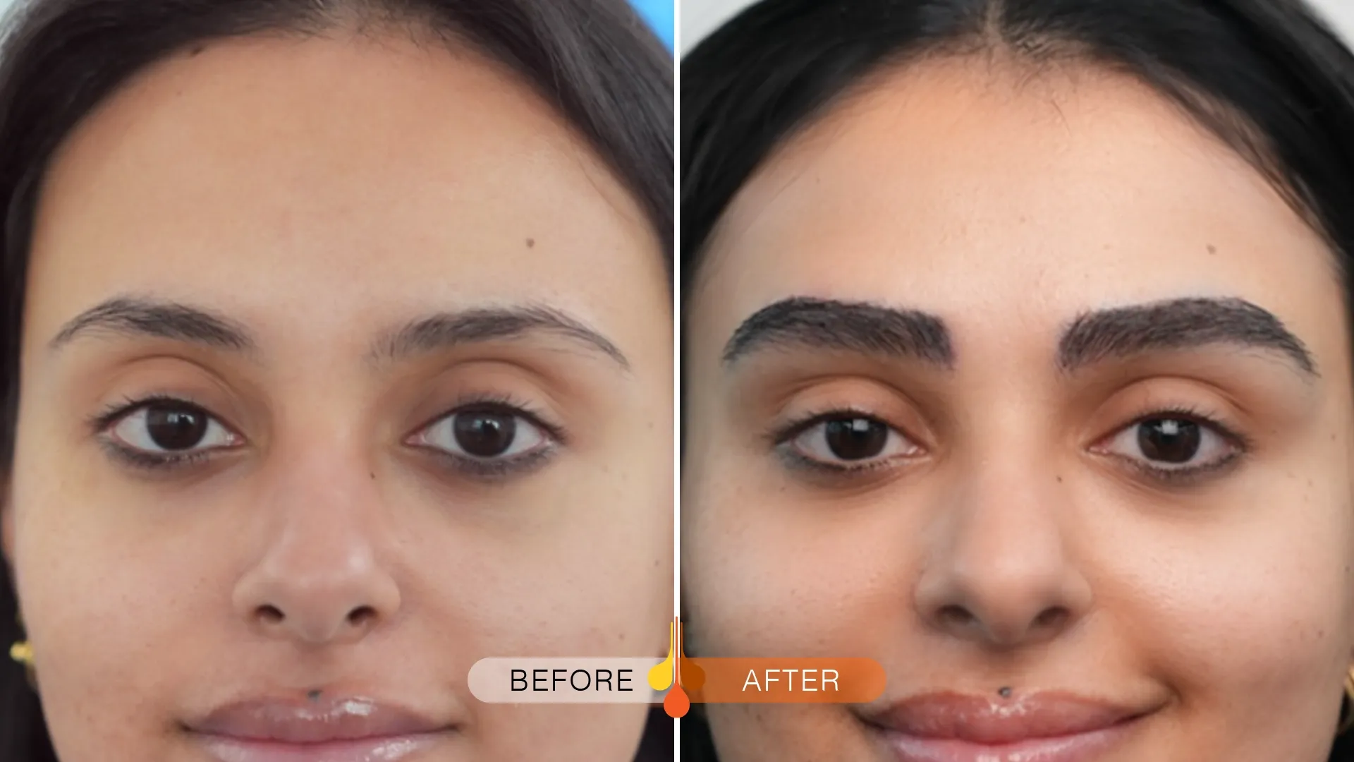 eyebrow-transplant-dubai-02