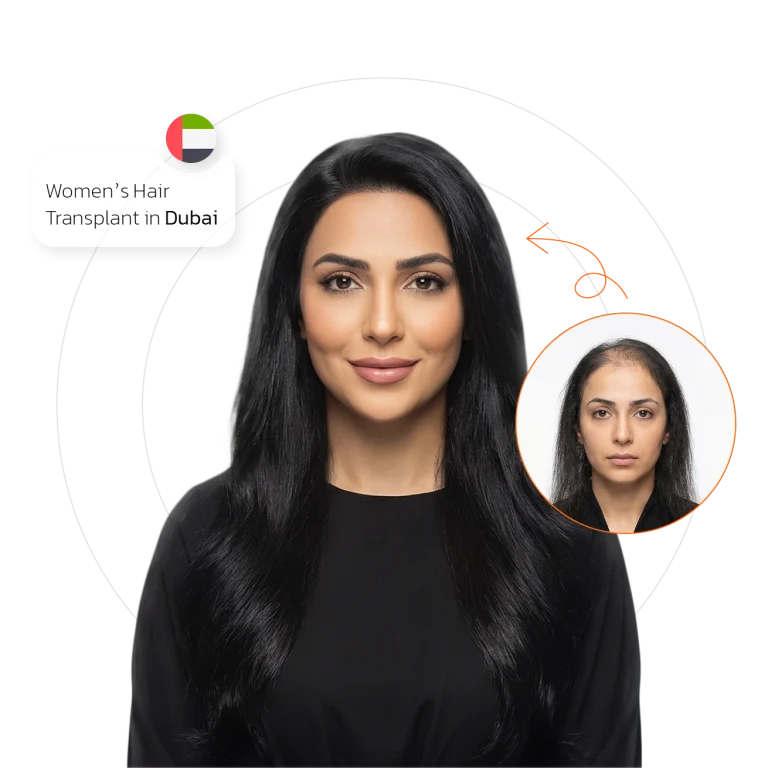 Women’s Hair Transplant in Dubai
