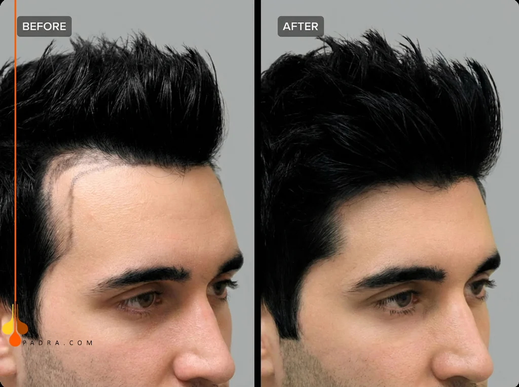 زراعة الشعر الجزئية