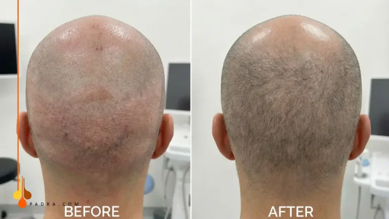 What Is the FUE Donor Area