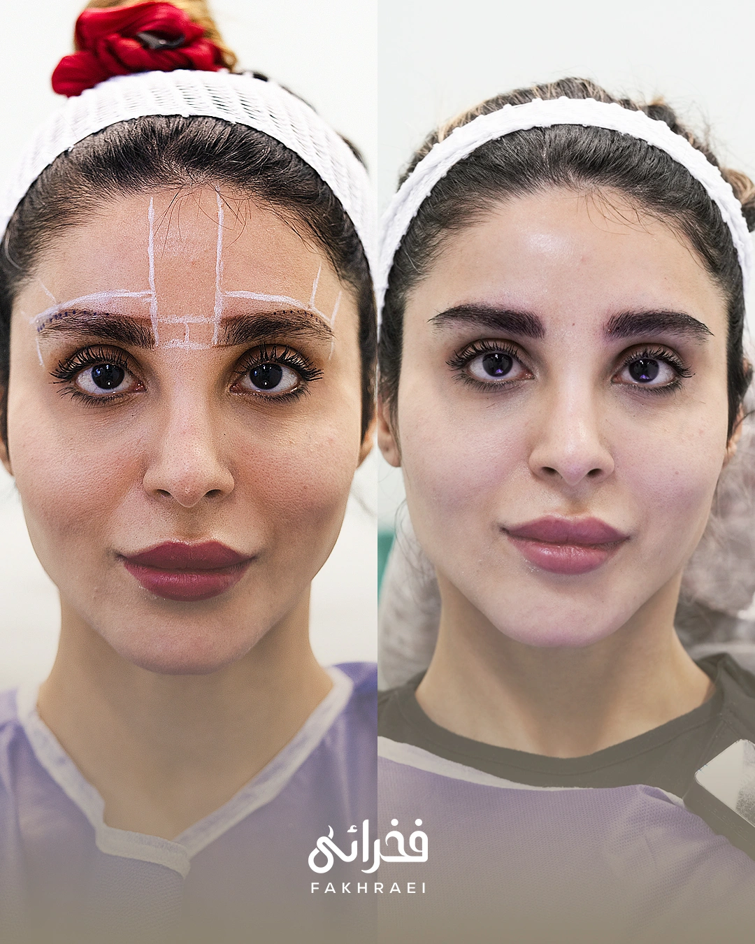 NTF eyebrow transplant fakhraei