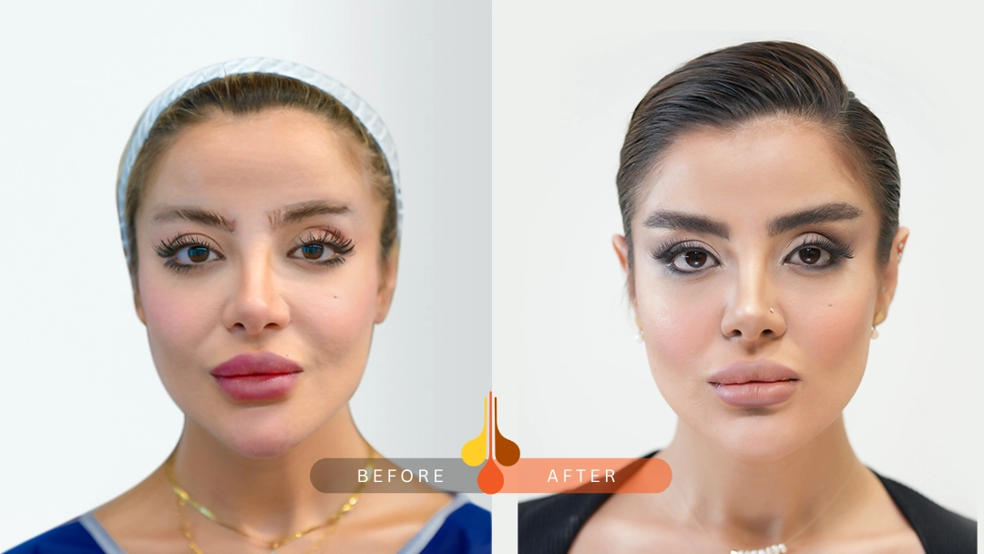 Eyebrow restoration before and after in Qatar