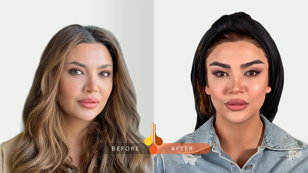 Natural eyebrow transplant results in Qatar