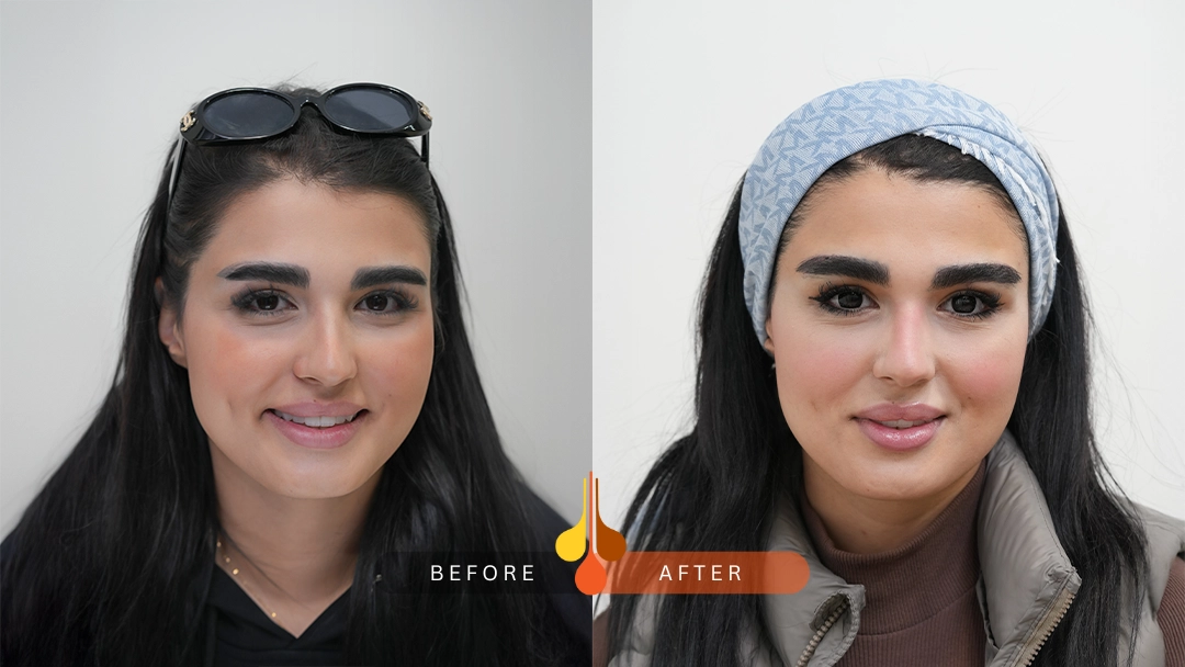 Before and after eyebrow transplant at Padra Clinic Doha