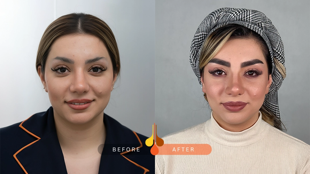 Natural eyebrow transplant results in Qatar