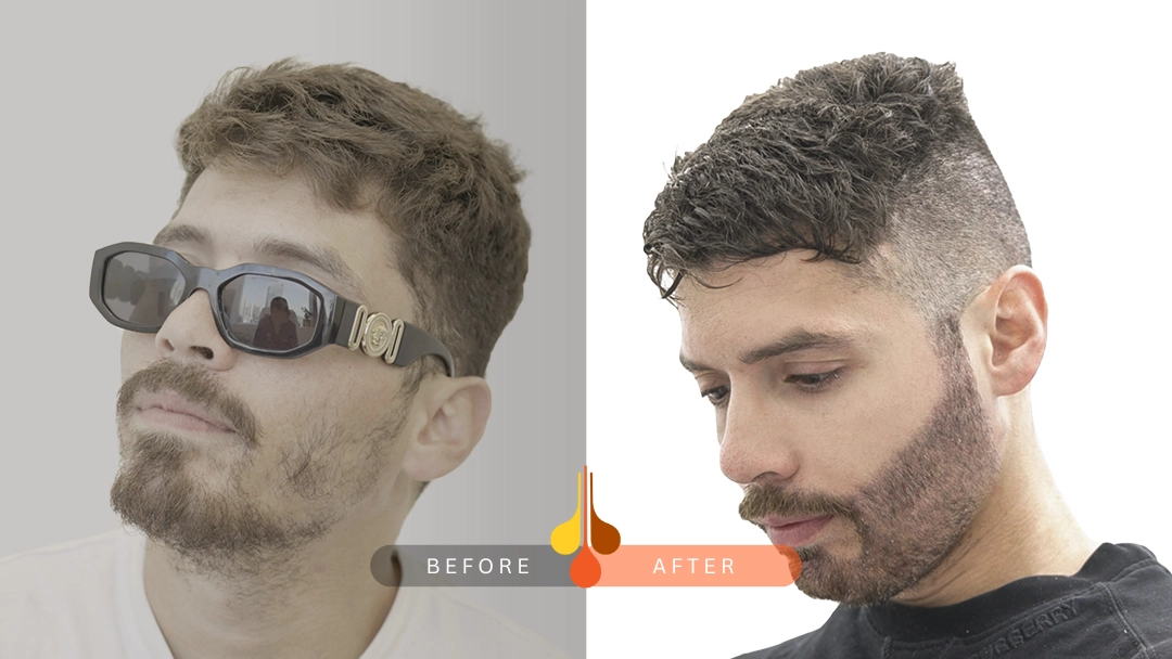 Before and after beard transplant at Padra Clinic Doha