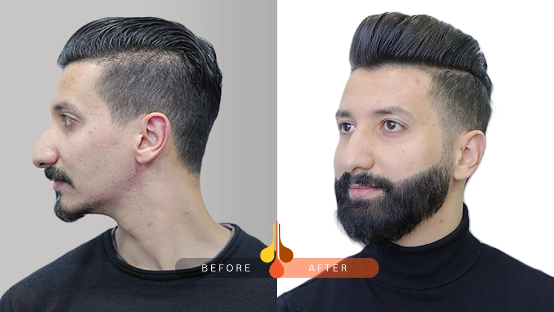 Before and after beard transplant at Padra Clinic Doha