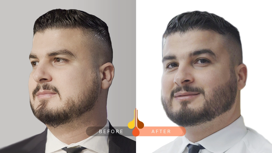 beard transplant Qatar before and after