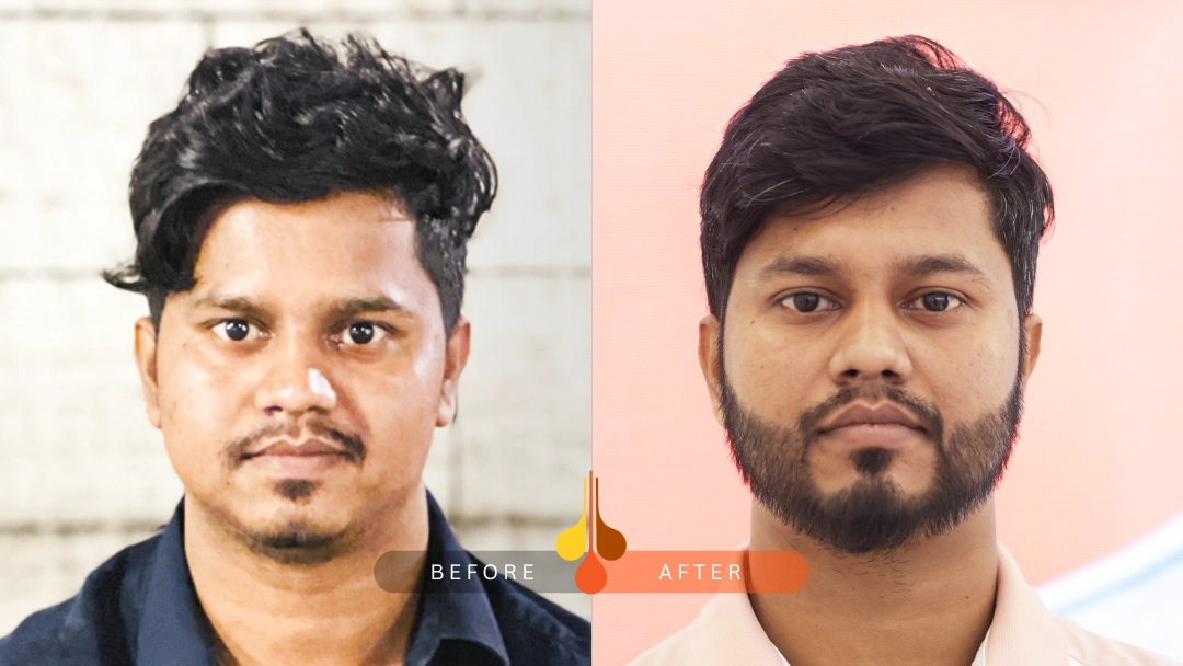 Beard transplant outcome at Padra Clinic Doha