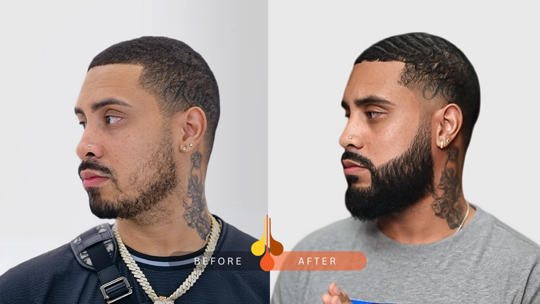 Before and after beard transplant at Padra Clinic Qatar