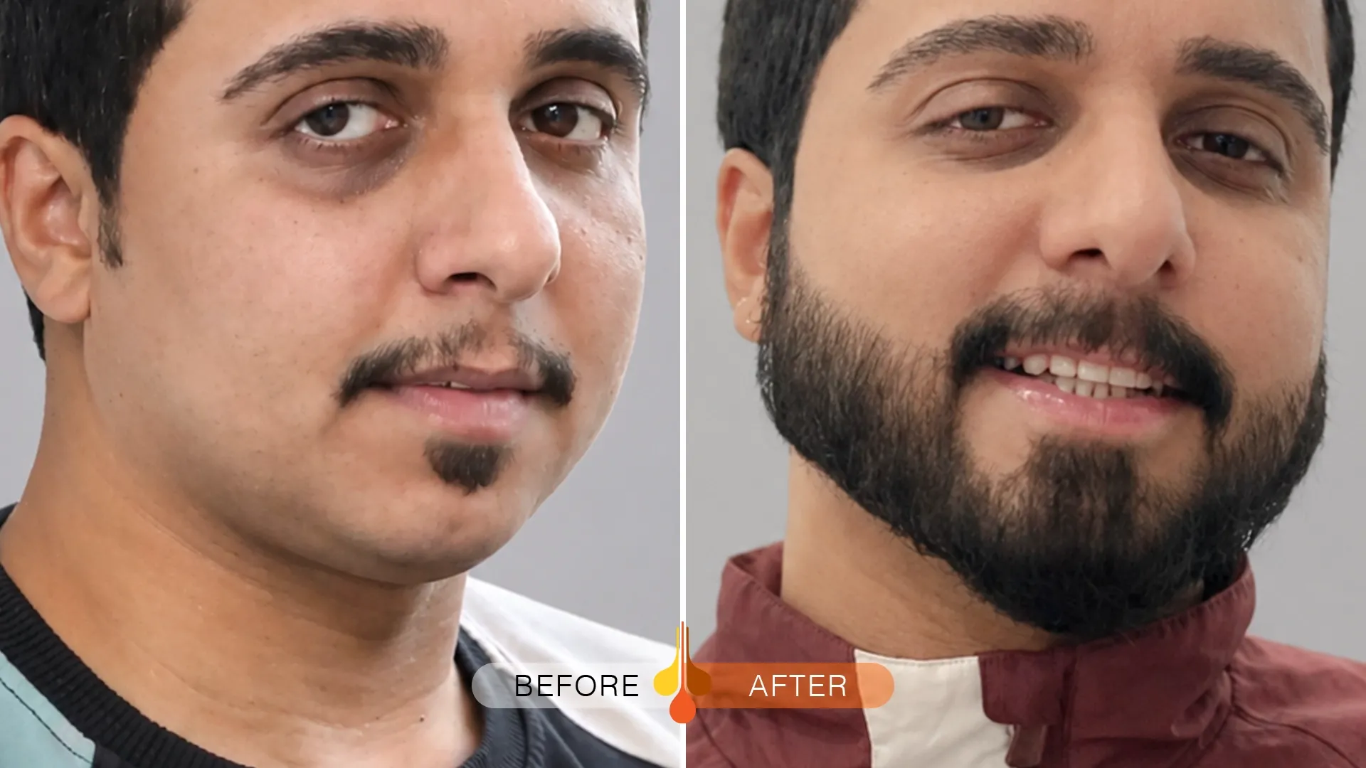 beard moustache transplant qatar