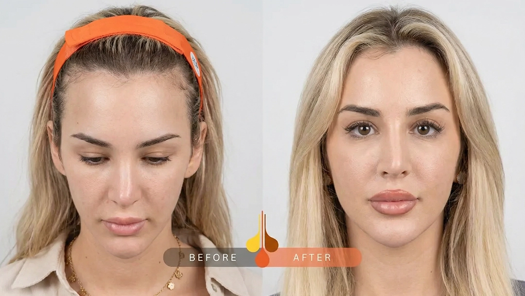 Natural-looking women's hair transplant in Qatar