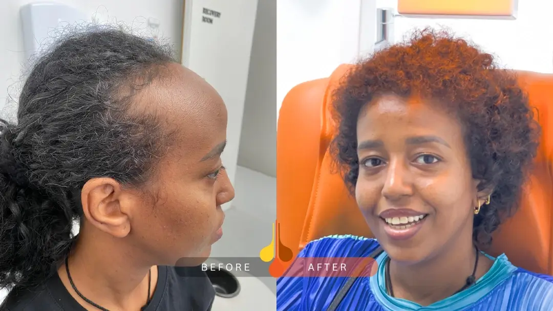 Real female hair transplant results in padra clinic Qatar