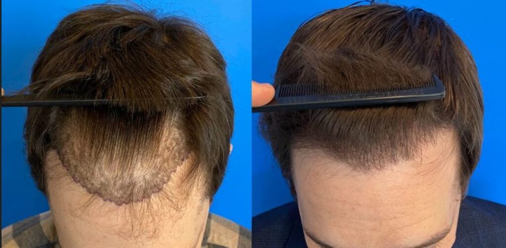 frontal-hair-restoration-before-after