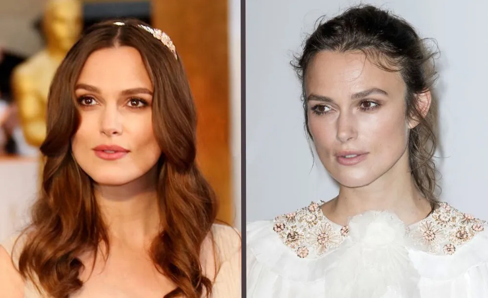 Hair Transplant Before and After