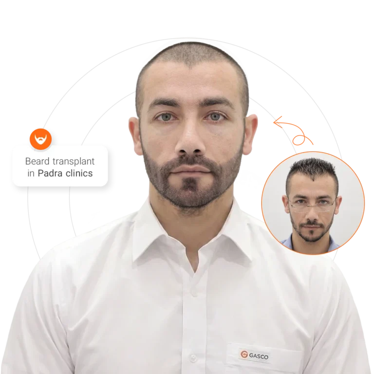Beard & Moustache Transplant in Saudi Arabia