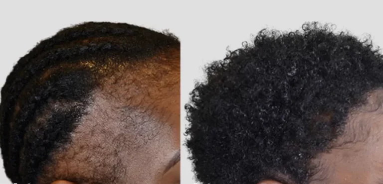 Afro Hair Transplant for Black Men