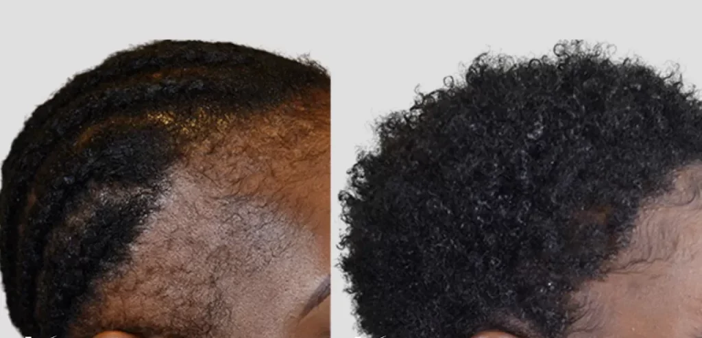 Afro Hair Transplant for Black Men