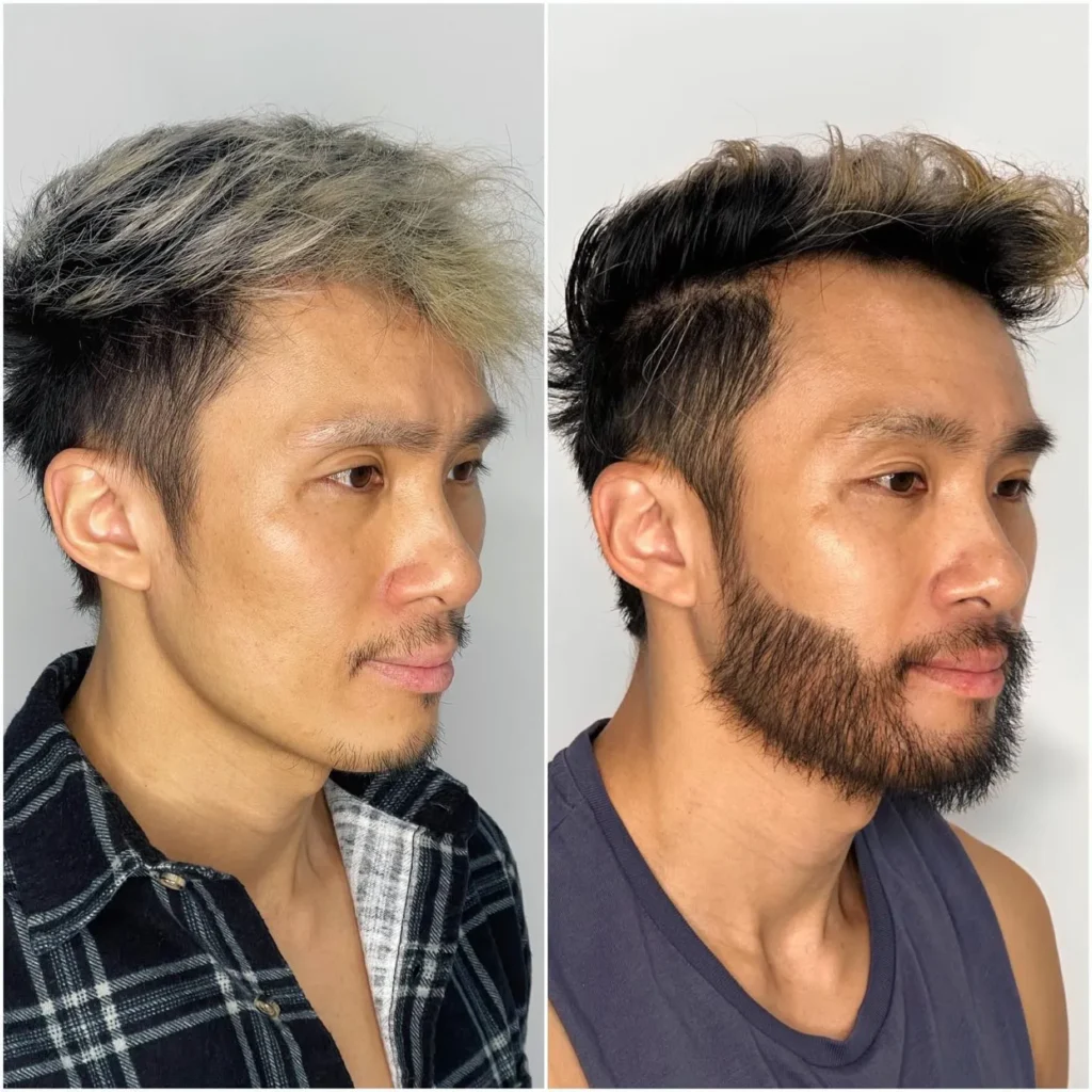 Beard Transplant Before and After