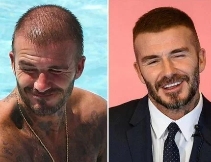 Celebrities With Hair Transplant