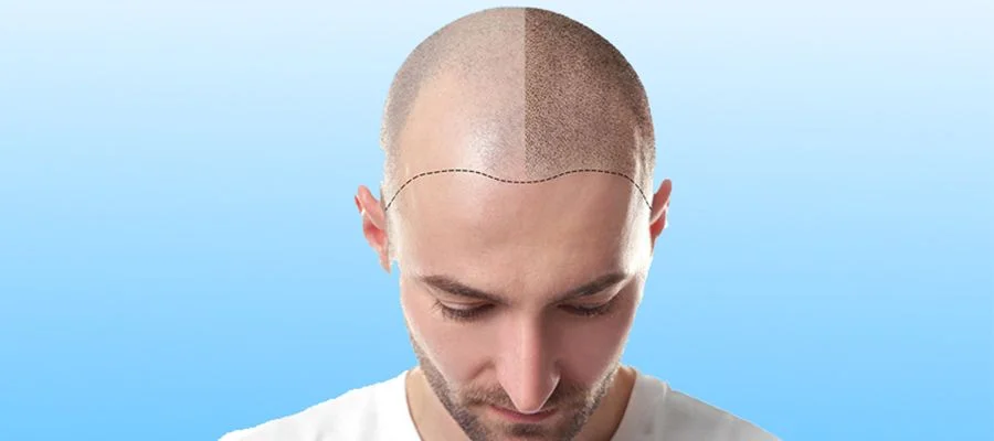 Beard Hair for Hair Transplant