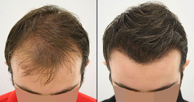 4000 Hair Grafts Before and After