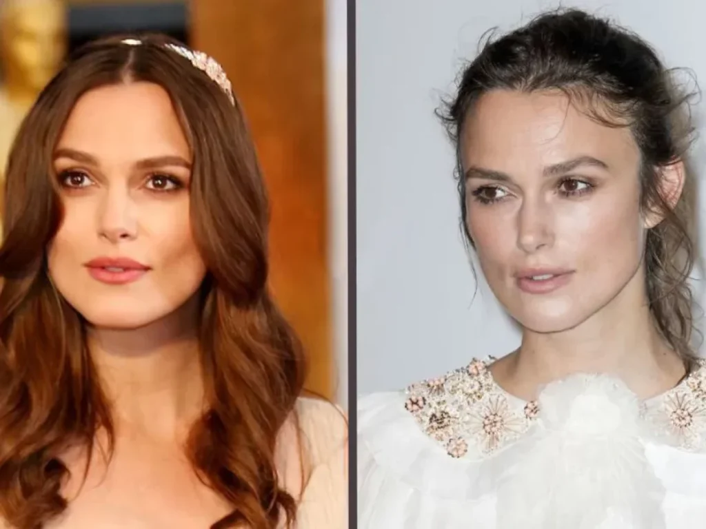 Celebrities With Hair Transplant