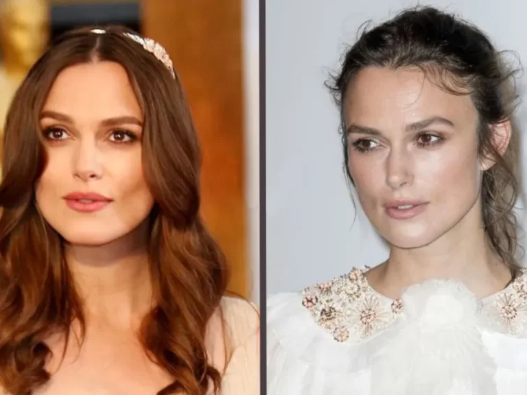 Celebrities With Hair Transplant