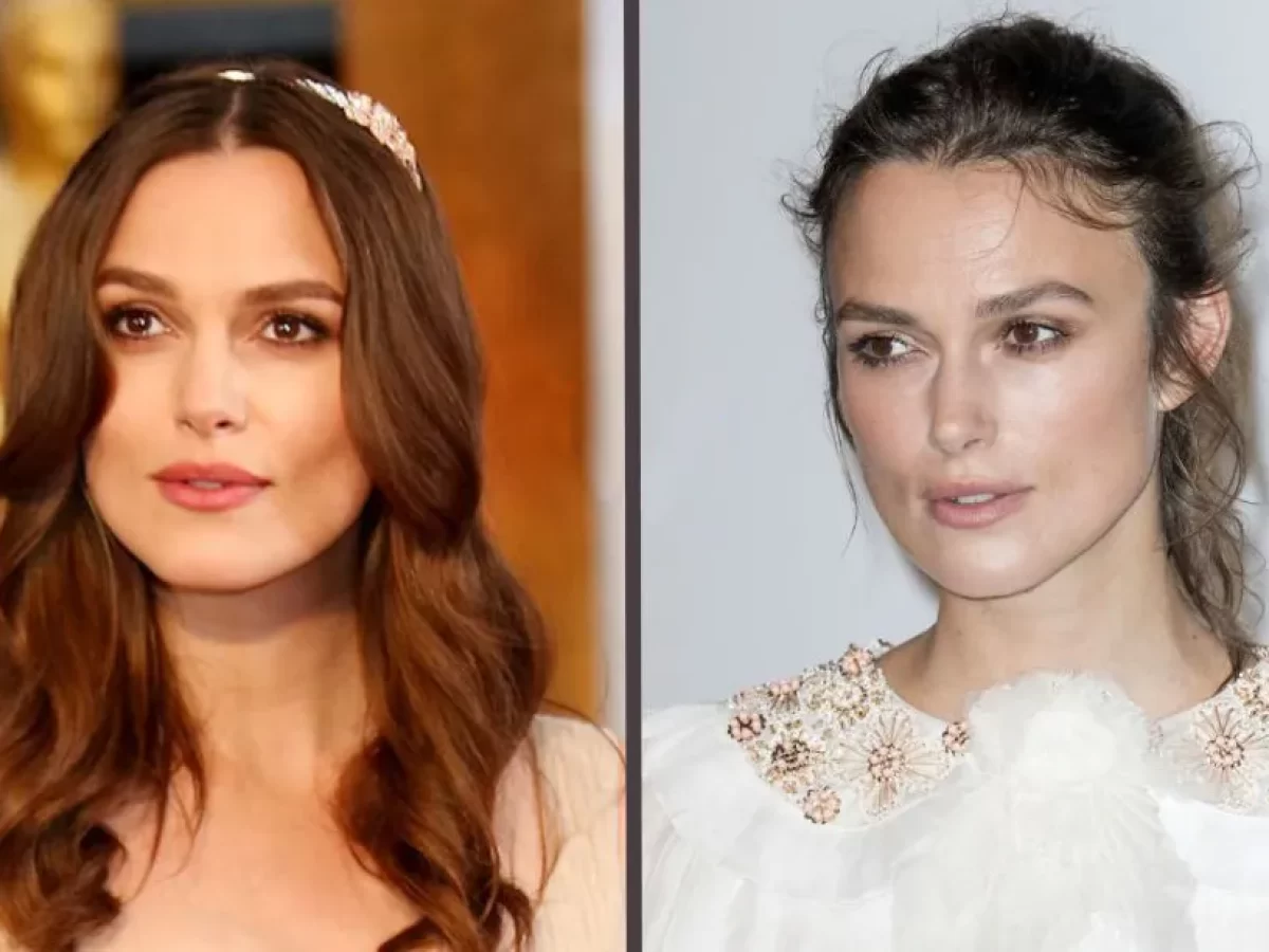 Celebrities With Hair Transplant