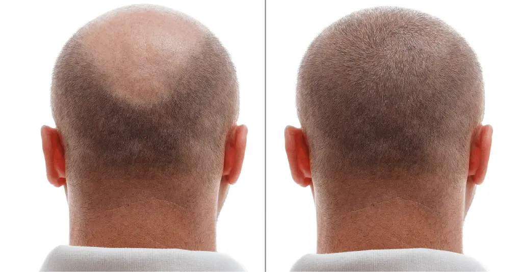 Poor hair transplant results