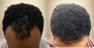 Afro Hair Transplant for Black Men