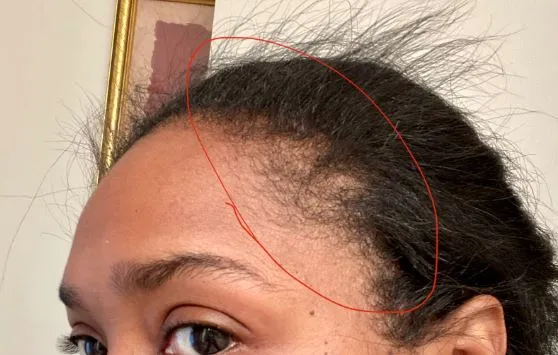 Hairline-Transplant-for-Edge