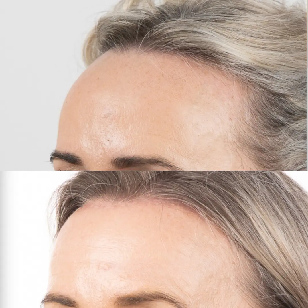 Hair Transplant to Reduce Forehead