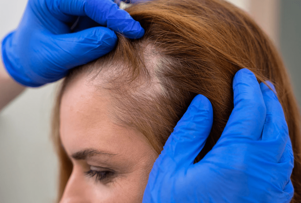 Hairline-Transplant-for-Edge