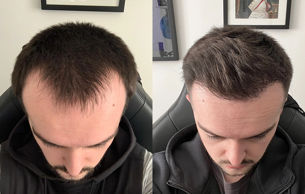 Hairline Surgery for Men