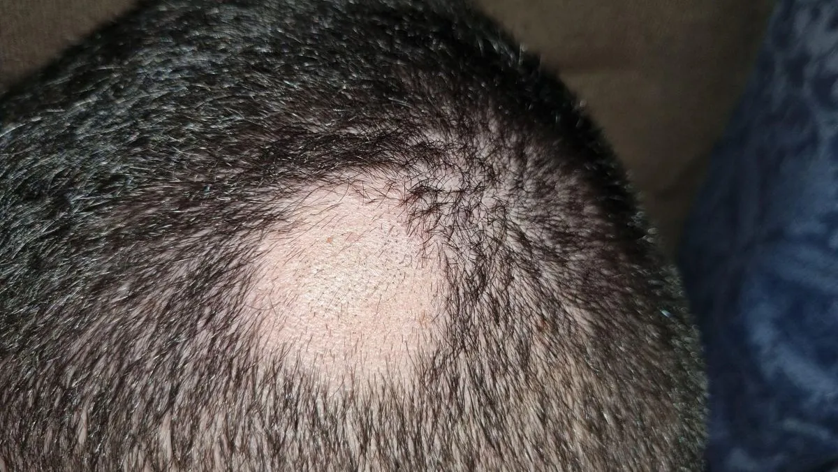 Can you get a hair transplant with alopecia
