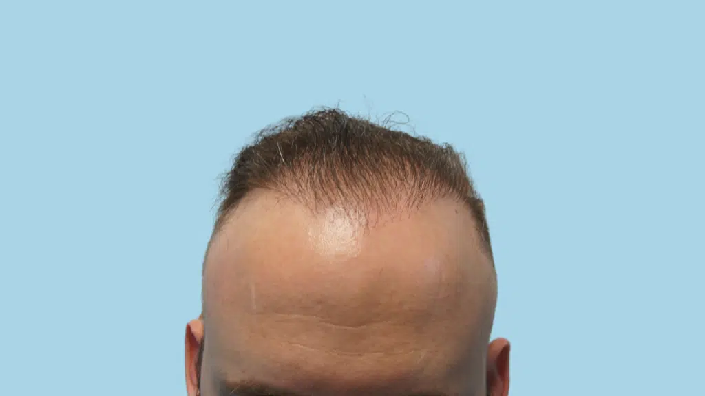 Hair Transplant Candidates