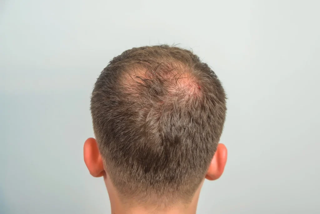 Hair Transplant Candidates