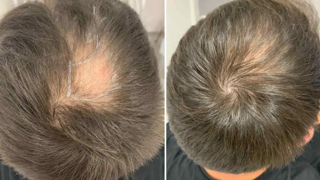 Can you get a hair transplant with alopecia