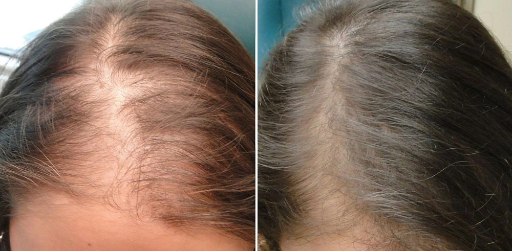 PRP Hair Results