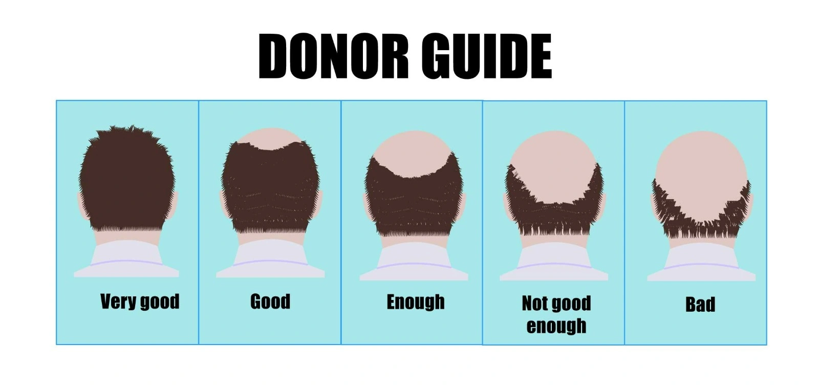 Hair Transplant With Donor Hair