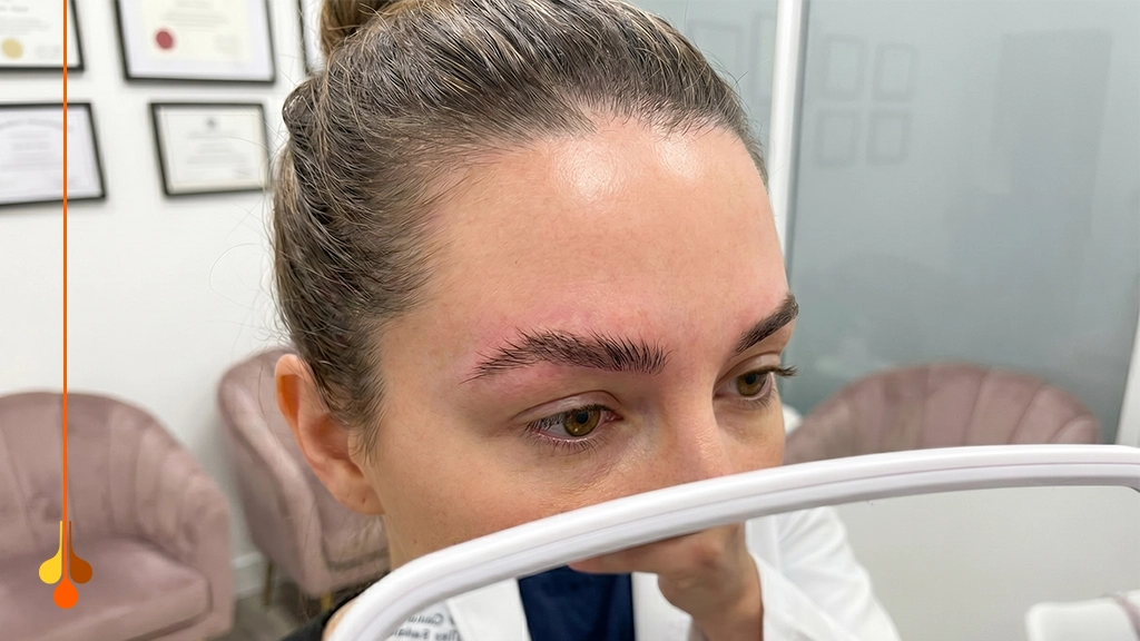 Eyebrow Transplant Asymmetry